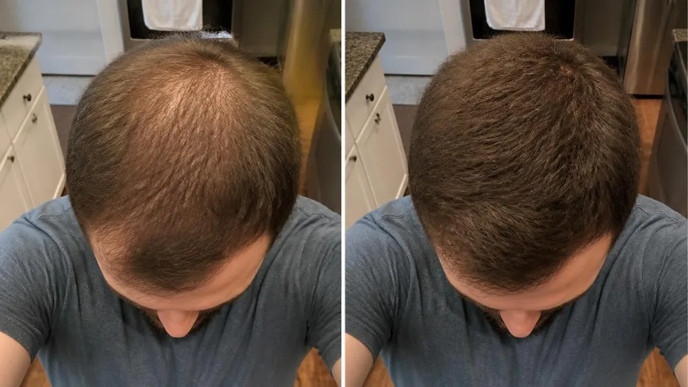 Antes y después en la zona con poco pelo con FIBRA tono marrón