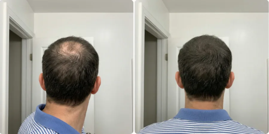 Antes y después en la parte de atrás de la cabeza