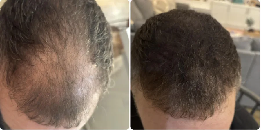 Antes y después en pelo rizado