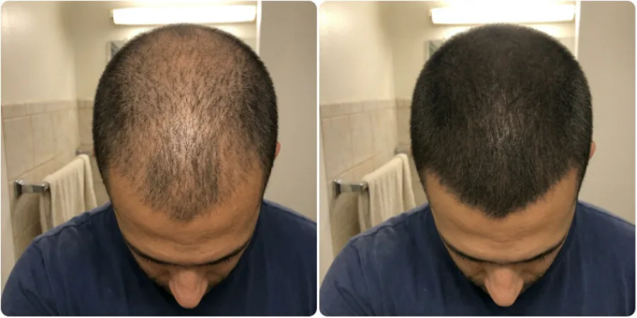 Antes y después con pérdida difusa
